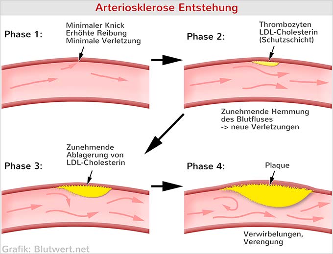 Entstehung von Arteriosklerose
