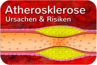 Arteriosklerose: Ursachen und Risiken